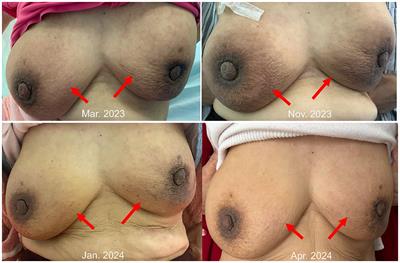 Case report: A case of Savolitinib in the treatment of MET amplification mutation advanced lung adenocarcinoma with rare bilateral breast metastasis